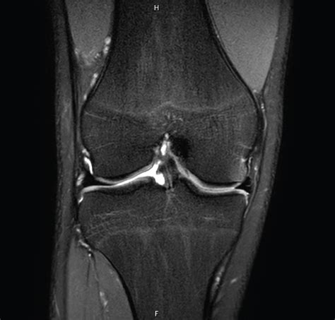 Isolated Avulsion Of The Biceps Femoris Insertion A Case Report And