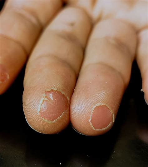 Fingertip Peeling Causes Remedies And Prevention Nails Ball