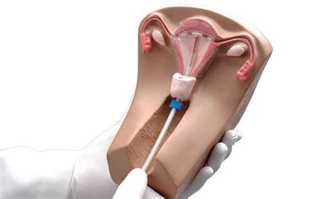 Iud Birth Control