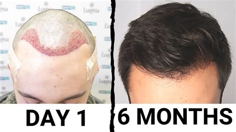 Hair Transplant Results After Months Tiera Danielson