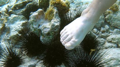 Sea Urchin Stuck In Foot