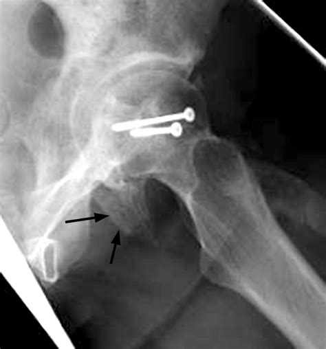 Femoral Head Fractures Trauma Orthobullets 56070 The Best Porn Website