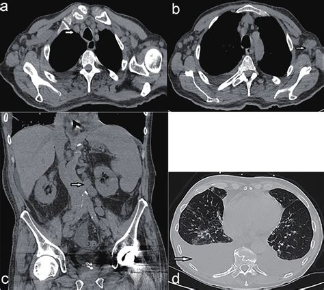 A Ct Scan Of The Chest Showing Mediastinal Lymphadenopathy Arrow