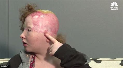 Girl Scalped On Omahaon Carnival Ride Speaks Out Daily Mail Online