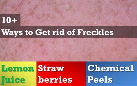 10 Ways To Get Rid Of Freckles Skin Disease Remedies