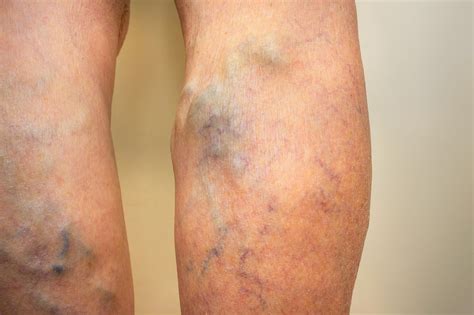 Es könnte ~~ embolie am anfang am größten. Case Report: Nephrotic Syndrome and Chronic HCV in a 72 ...