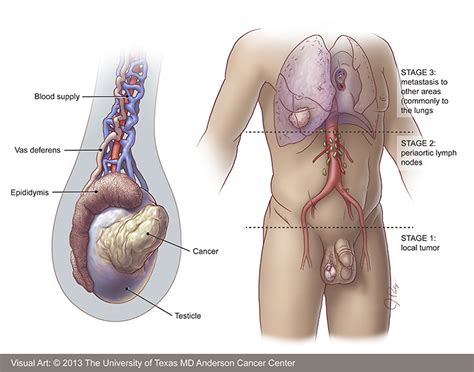 testicular cancer diagnosis md anderson cancer center