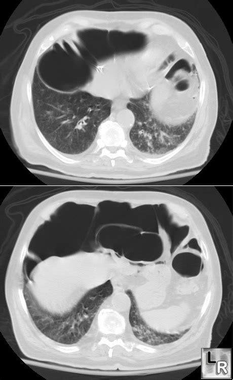 Radiology Pregnancy Infection And Treatment Chest Radiology 1 50