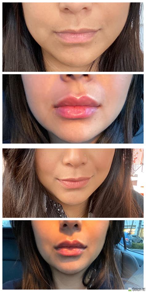 500 squats a day 30 day squat challenge | before and after results : Got lip filler today - Pic of lips before and immediately ...
