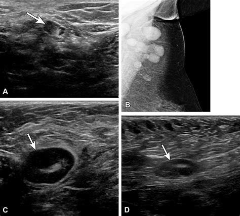 Axillary Lymphadenopathy In The Covid 19 Era What The Radiologist