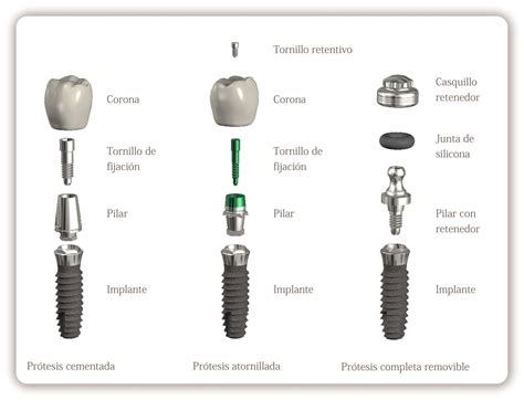 ¿ Qué Son Los Implantes Dentales En 2023 Implantes Dentales Dental Higienista Dental