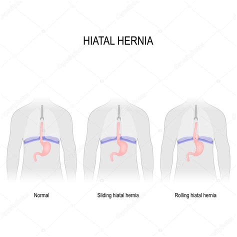 Hernia De Hiato Diagrama Vectorial De Diferentes Tipos De Hernia De