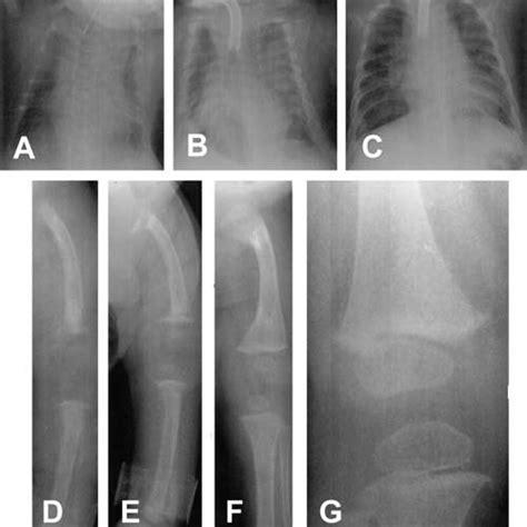 Pdf Congenital Rickets Caused By Maternal Vitamin D Deficiency