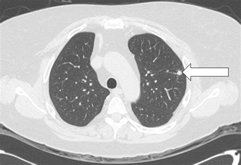 Corticotropin Dependent Cushing Syndrome Role For Inferior Petrosal