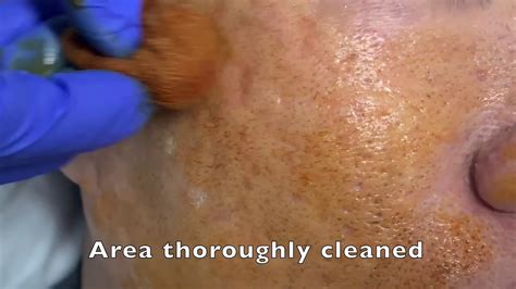 Acne Scar Subcision Full Video Youtube