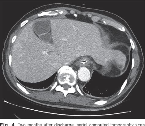 Figure 4 From Pyogenic Liver Abscess Caused By Endoscopic Submucosal