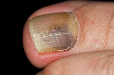 Black Toe Fungal Infection Fungal Nail Infection Onychomycosis We