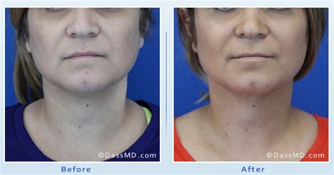 Beverly Hills Chin Liposuction Results Before And After Photos