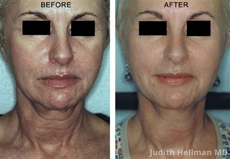 Skin Tightening Before And After Photos Nyc