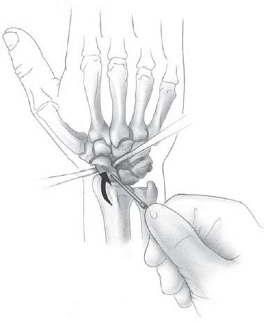 Lippincott williams & wilkins, 2001, pp. 37 Proximal Row Carpectomy for Scaphoid Nonunion ...