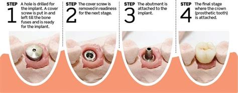 Step By Step Dental Implant Procedure Photos