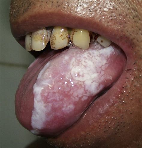 Preoperative Photograph Of A Patient With Leukoplakia Over The Left