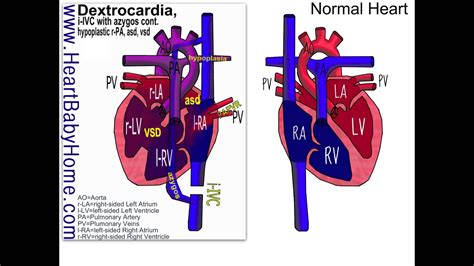 Heart Defect Video Explanation 55 Dextrocardia Papvr Azygos