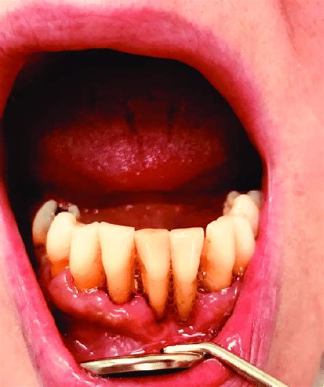 Periodontitis Afflicted Lower Front Teeth In The Mandible Download
