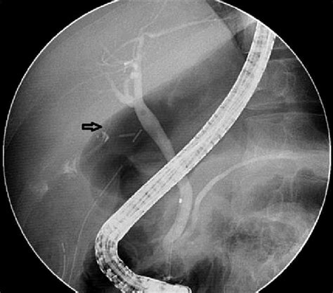 Cholangiogram Showing A Bile Leak Originating From A Thin Duct Of