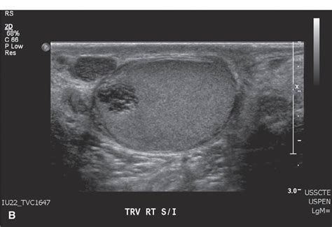 Ultrasound Of The Acute Scrotum My Xxx Hot Girl