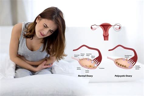 The Warning Signs Of Polycystic Ovary Syndrome Twiniversity