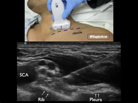 Supraclavicular Brachial Plexus