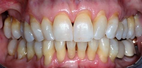 Gum Recession Createsmiles By Dr Brad Lockhart Tustin Dentist