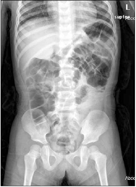 A Simple Abdominal X Ray This Figure Showed Bowel Dilatations
