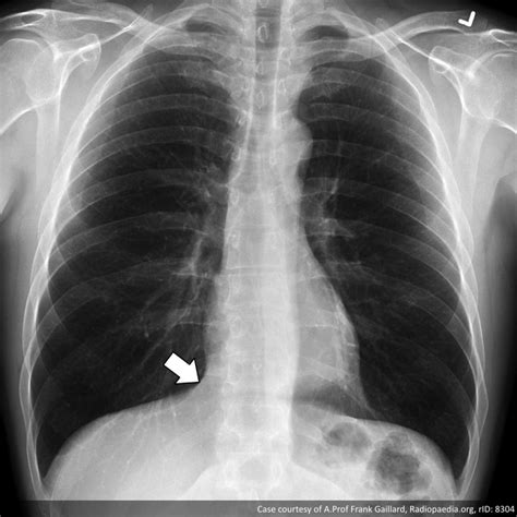 Chest Pa View Radiology Reference Article
