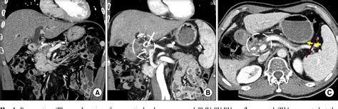 Figure 1 From Pancreaticoduodenectomy With Combined Hepatic Artery And