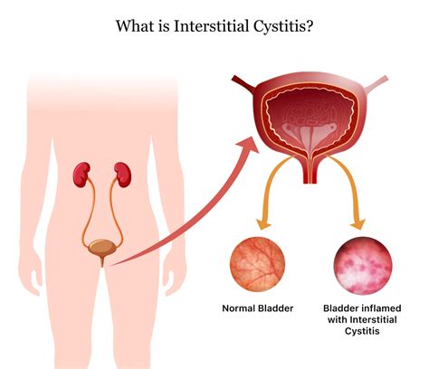 Interstitial Cystitis Symptoms Causes Treatment Living With IC