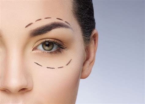 Revision Eyelid Surgery Revision Blepharoplasty St Louis Mo