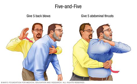 Choking First Aid Mayo Clinic Choking First Aid First Aid Procedures Back Blows Infant Cpr