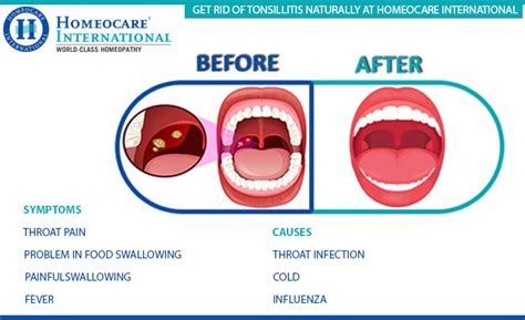 Homeocare International Best Place For Tonsillitis Treatment