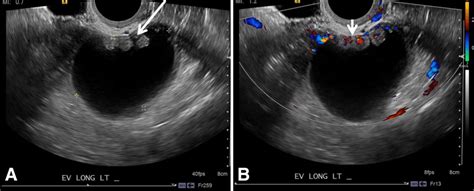 Serous Borderline Tumor Endovaginal Ultrasound Images Of A 42 Year Old