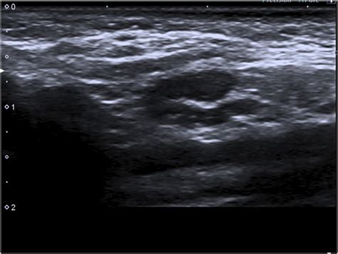 Ultrasound Of Benign Appearing Right Axillary Lymph Node On First