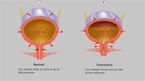 Overactive Bladder Causes Risk Factors Symptoms Everyday Health