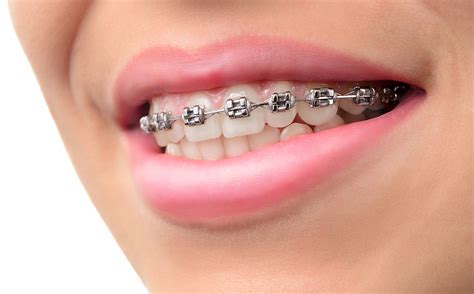 What To Know About Adult Braces The Pros And Cons