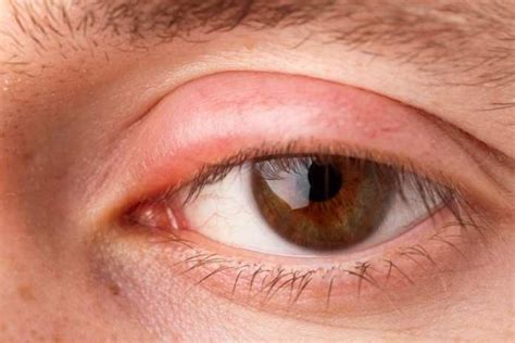 Top 20 Early Symptoms Of Pink Eye You Should Never Ignore Beta