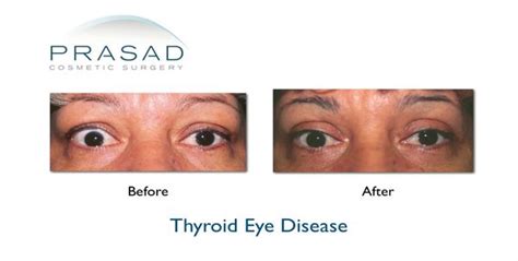 Thyroid Eye Disease Graves Disease Prasad Cosmetic Surgery Ny