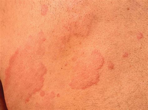 Cold Rash Cold Urticaria Overview And More