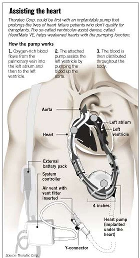 Heart Pumps Future In Fdas Hands Device Offers Hope In Some Cases