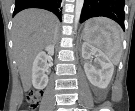 Renal Laceration Left Kidney Kidney Case Studies Ctisus Ct Scanning
