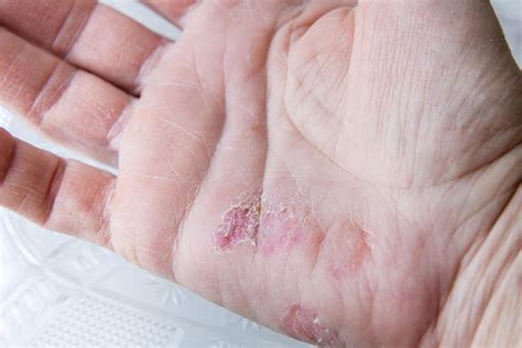 Skin Rashes On Hands